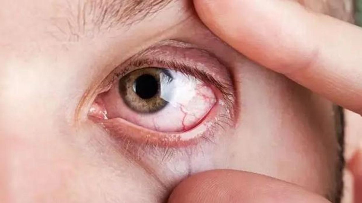 Ellerinizi Değdirmeyin: Görme Sorunlarına Neden Oluyor! Hızla Uygulayın