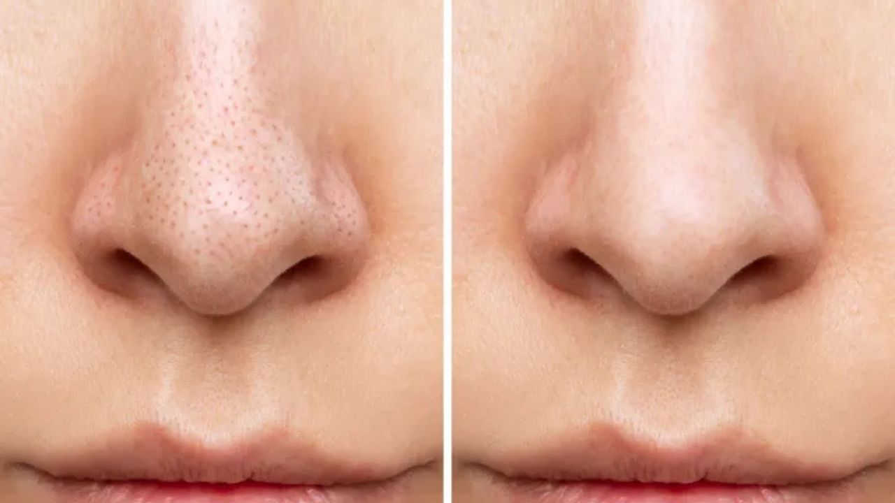 Burnunuzdaki Siyah Noktalara Müdahale Etmeyin! Dermatologlardan Kritik Uyarı: "Büyük Hata Yapıyorsunuz"