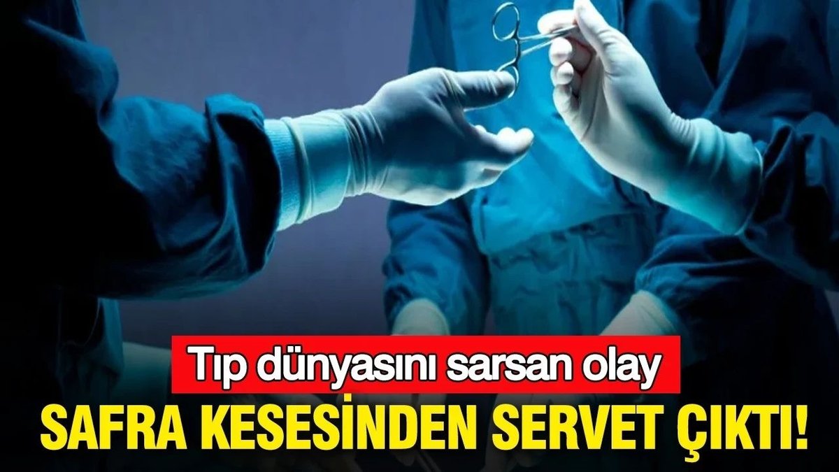 Bingöl’de Şaşırtan Tıbbi Vaka: Safra Kesesinden 2 Bini Aşkın Taş Çıkarıldı