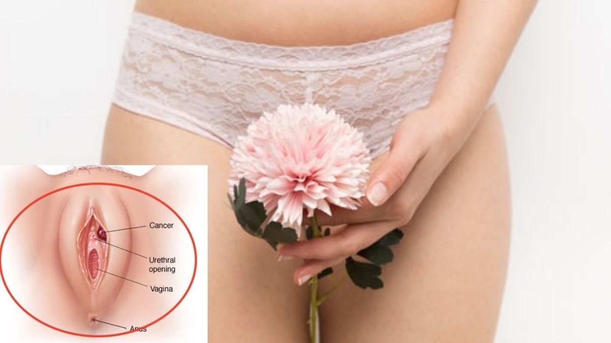 Vulva Kanseri Belirtileri Nelerdir? Uzmanlar Erken Teşhisin Önemine Dikkat Çekiyor