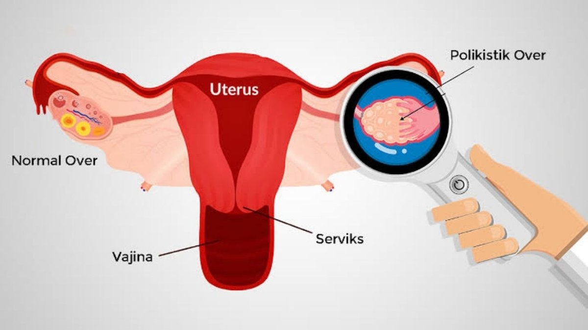 Polikistik Over Sendromu (PCOS) Nedir?