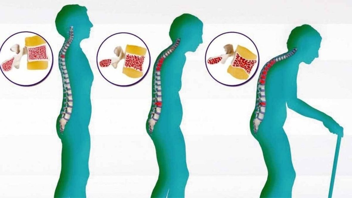 Osteoporoz: Kadınlarda Kemik Erimesi Risk Faktörleri ve Korunma Yolları