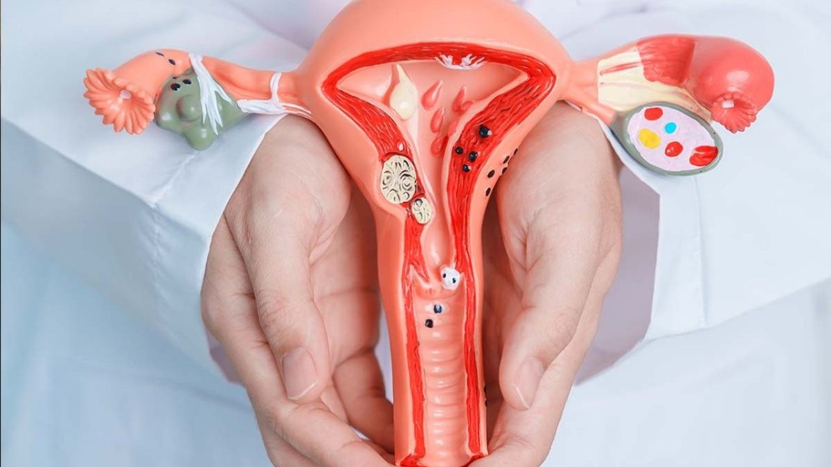 Endometriozis Nedir? Belirtileri, Nedenleri Ve Tedavi Yöntemleri