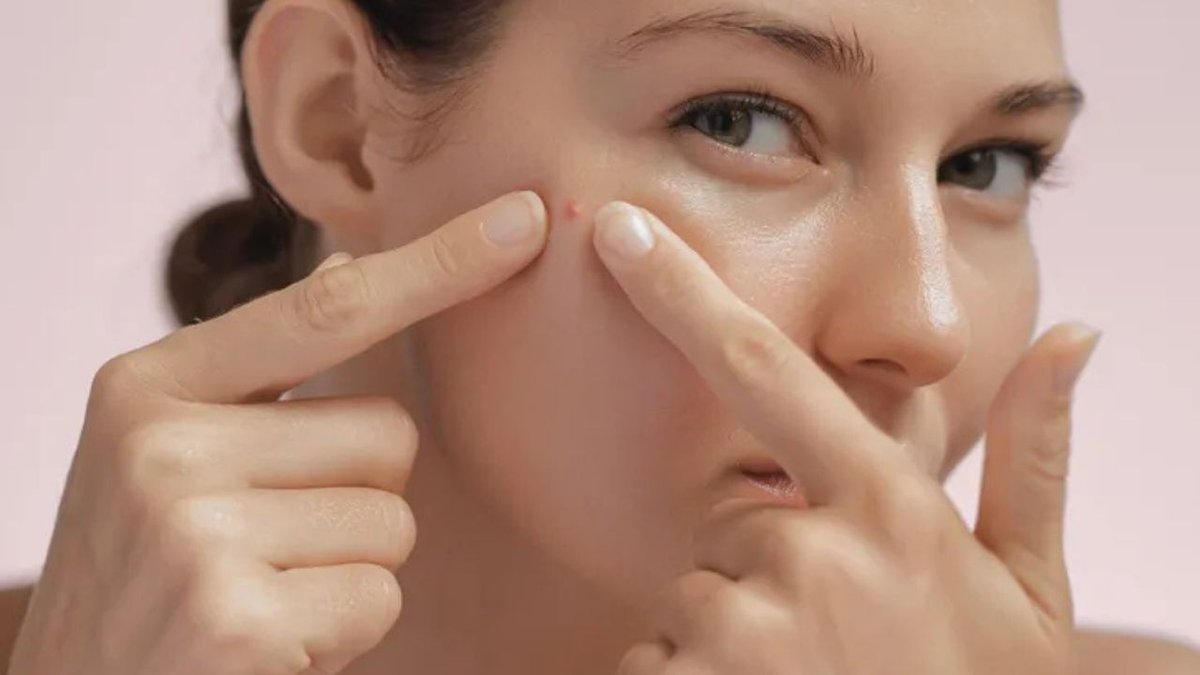 Geçmeyen Sivilcelerin Sebebi O Alışkanlık Olabilir! Dermatologlardan Kritik Uyarılar