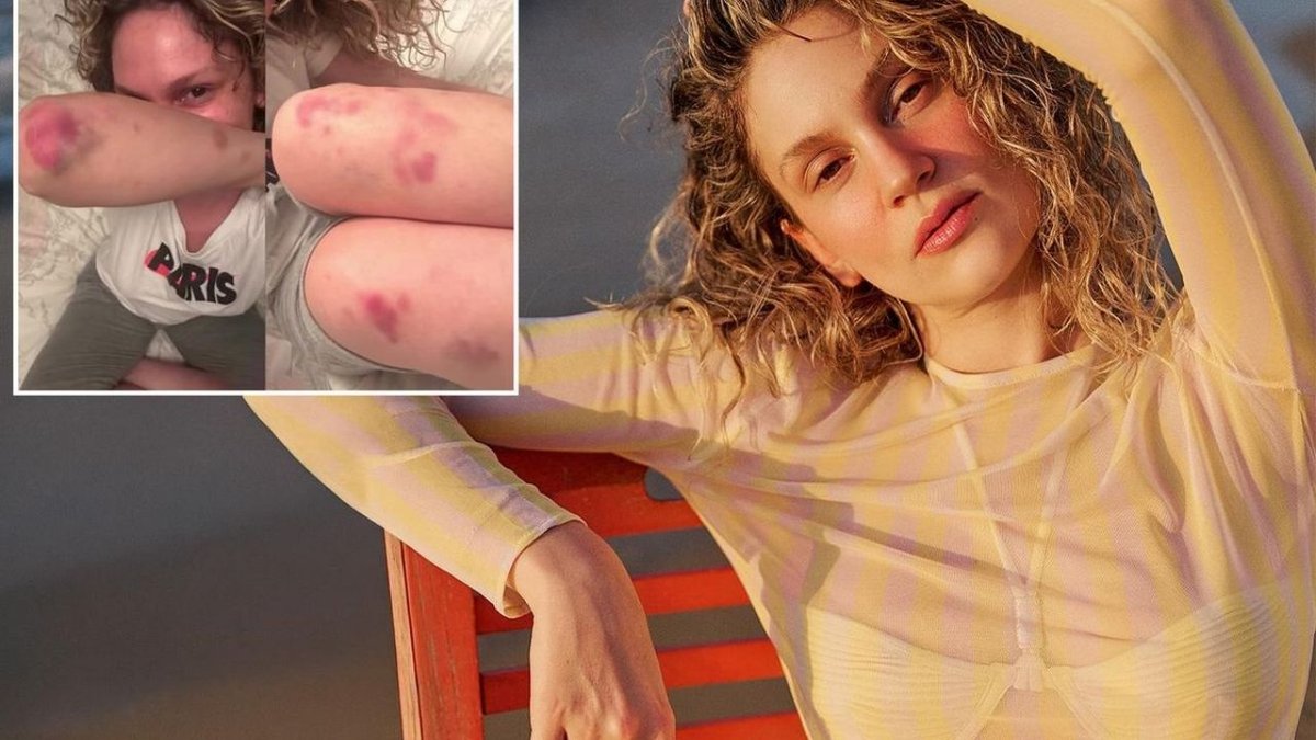 Farah Zeynep Abdullah’ın Çekimlerdeki Morlukları Hayranlarını Endişelendirdi