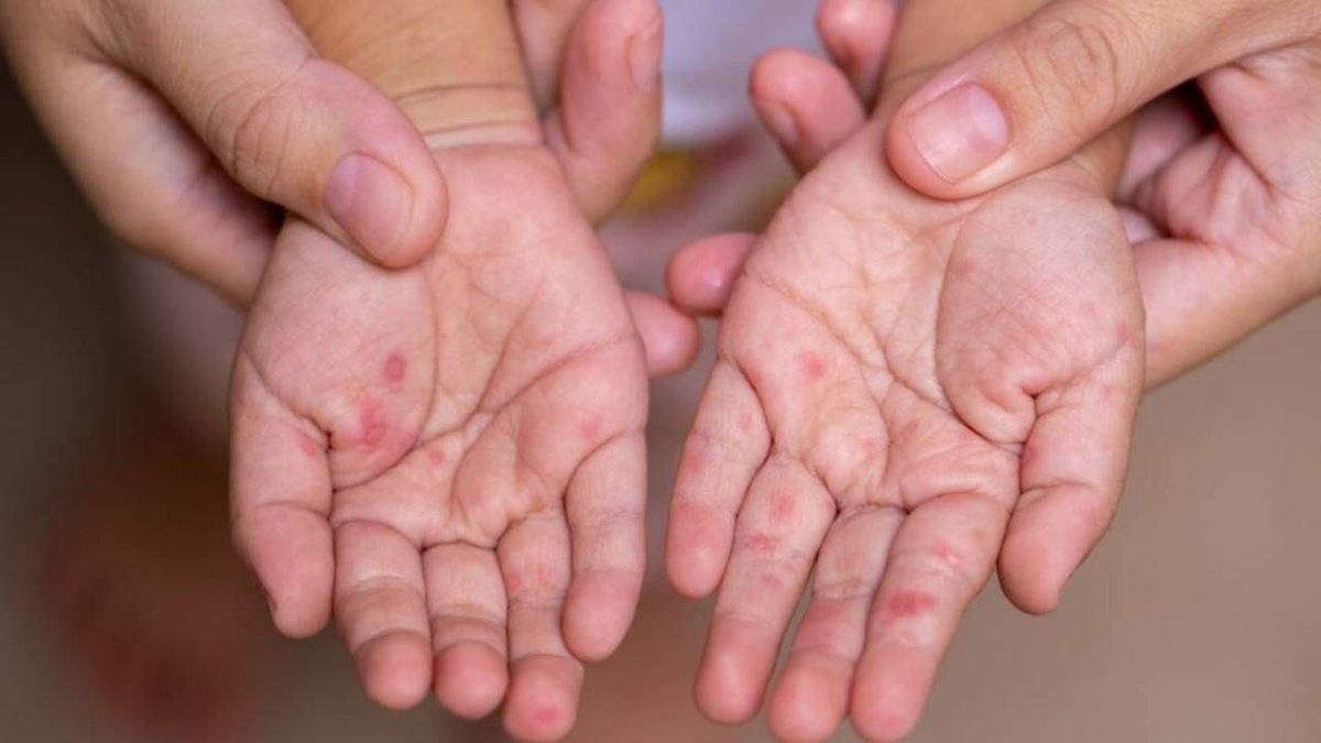 İngiltere’de Kızamık Faciası: 2 Çocuk Hayatını Kaybetti, Uzmanlardan Aşı Uyarısı